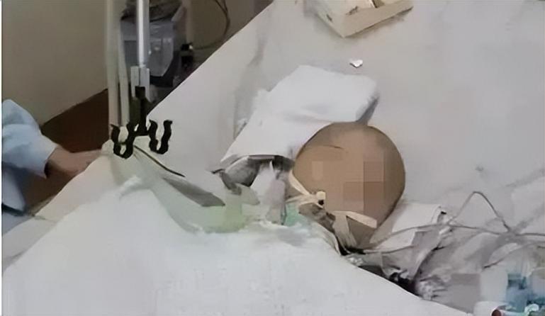 婴儿疑遭用力摇晃致脑出血-婴儿摇晃颅内出血会有什么症状